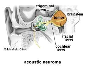 Acoustic Neuroma Facial Nerve 113